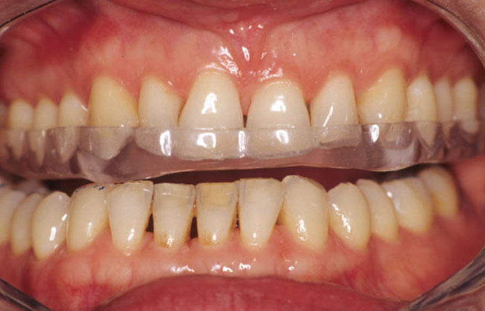 bruxisme_et_usure_dentaire