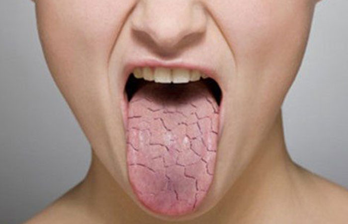 secheresse_buccale