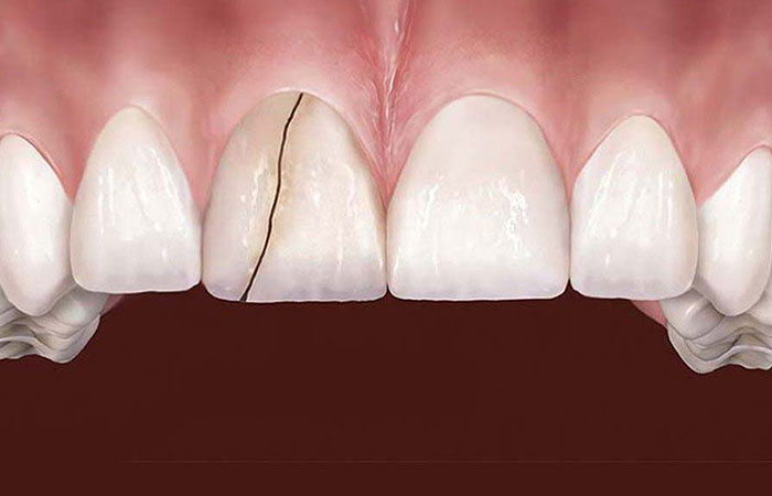 syndrome_de_la_den_felee